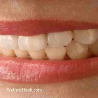 जानिए दांत पीले (Yellow Teeth) क्यों होतें है ? घरेलु उपाय !