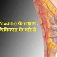 स्तन शोथ (Mastitis) क्या है ? मस्तिटिस के कारण लक्षण और चिकित्सा हिंदी में जानकारी |