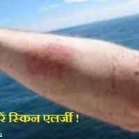 त्वचा पर होनेवाली एलर्जी के घरेलू उपाय - Skin Allergy Home Remedy In Hindi