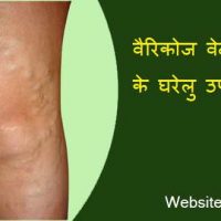 Varicose Veins क्या है? वैरिकोज वेन्स के घरेलु उपाय हिन्दीमें |